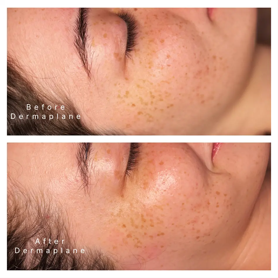 Benefits of Dermaplaning
